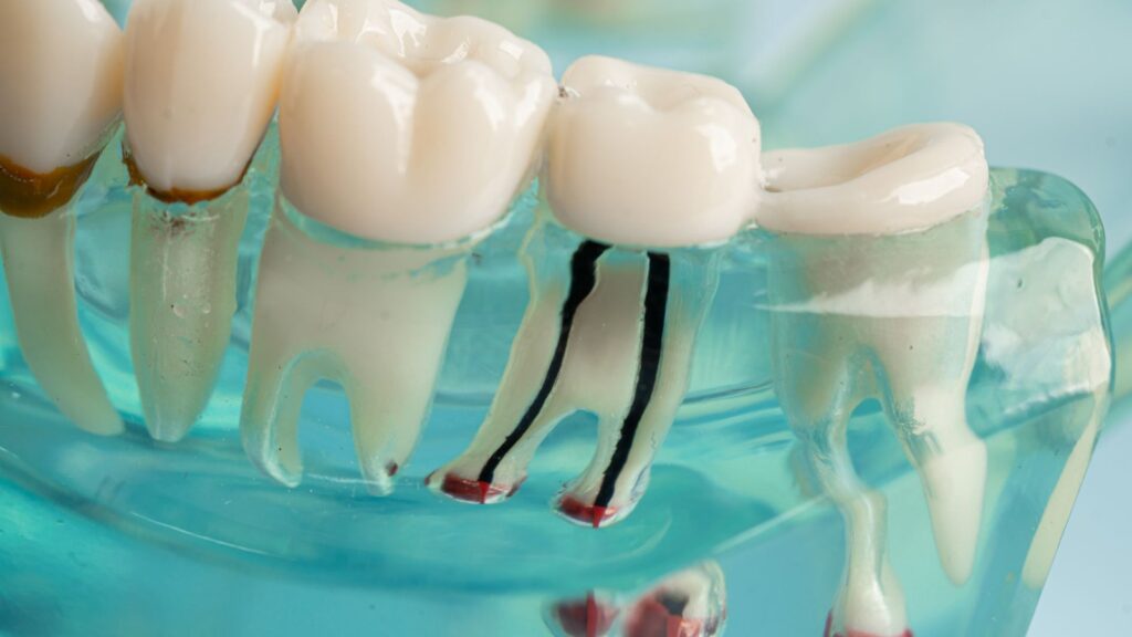 Root Canal Facts