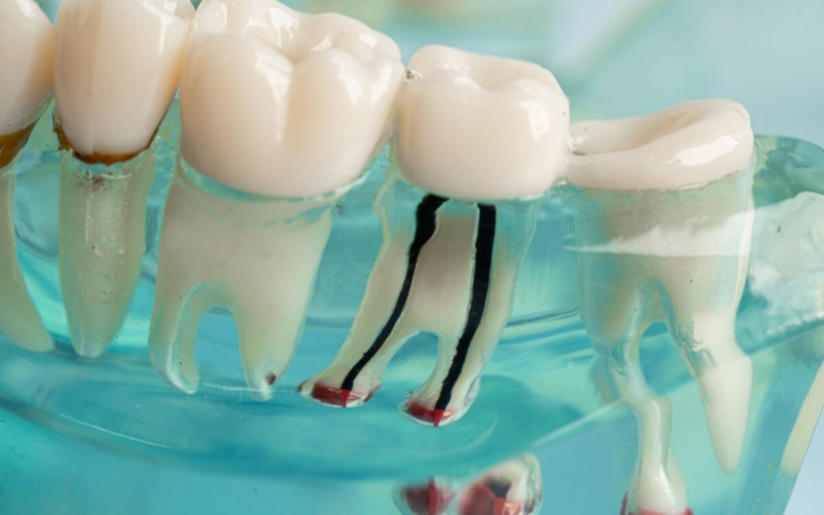 Root Canal Facts