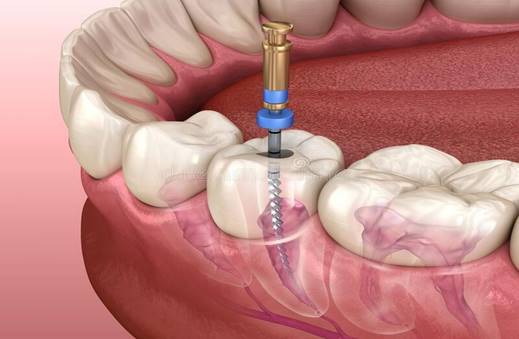 Do You Need an RCT? 7 Warning Signs to Watch For?