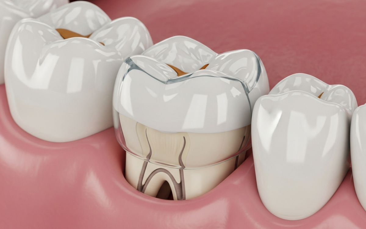 Dental Crowns After Root Canal Therapy: Protecting Your Treated Tooth