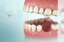 What Happens When a Missing Tooth Is Left Untreated?